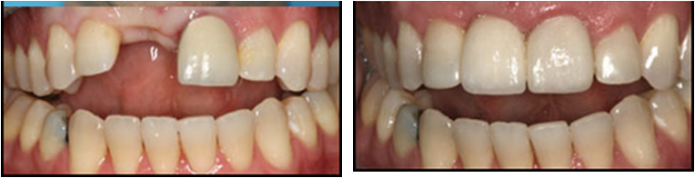 Răng toàn sứ rất thích hợp để thay thế cho các răng cửa bị mất 