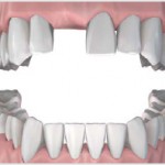 Phục hình răng sứ cố định