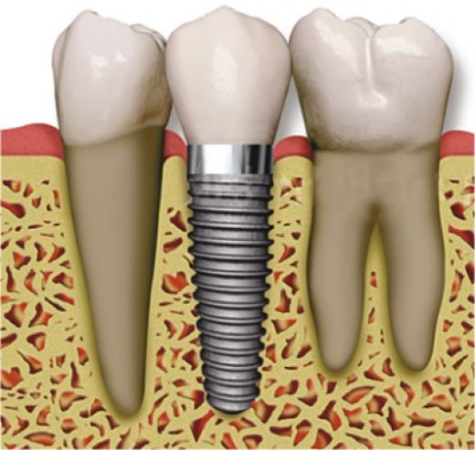 dental_implant_01