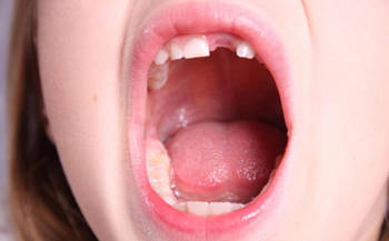 Thay răng sữa là thời điểm quan trọng ảnh hưởng tới thẩm mỹ răng vĩnh viễn sau này