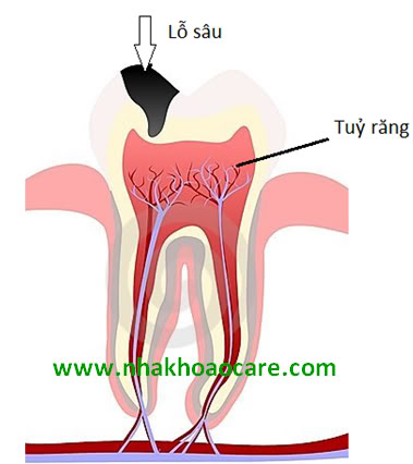 Sâu răng gây tổn thương đến tủy răng