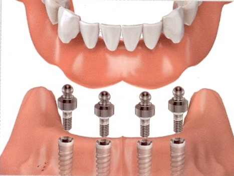 Mô hình trồng răng sứ bằng phương pháp phục hình Implant toàn hàm