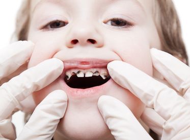 Sâu răng ảnh hưởng đến quá trình mọc răng vĩnh viễn của trẻ