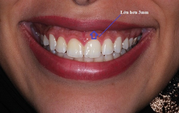 khoảng cách từ cổ răng đến vành môi trên không vượt quá 3mm là bình thường. Nếu vượt quá sẽ gọi là cười hở lợi.