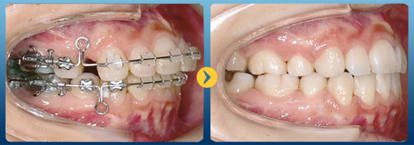 Niềng răng đúng cách để răng mọc theo mô răng ban đầu
