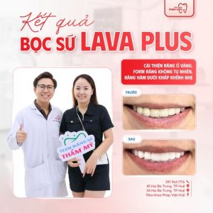 Bọc răng sứ Lava Plus