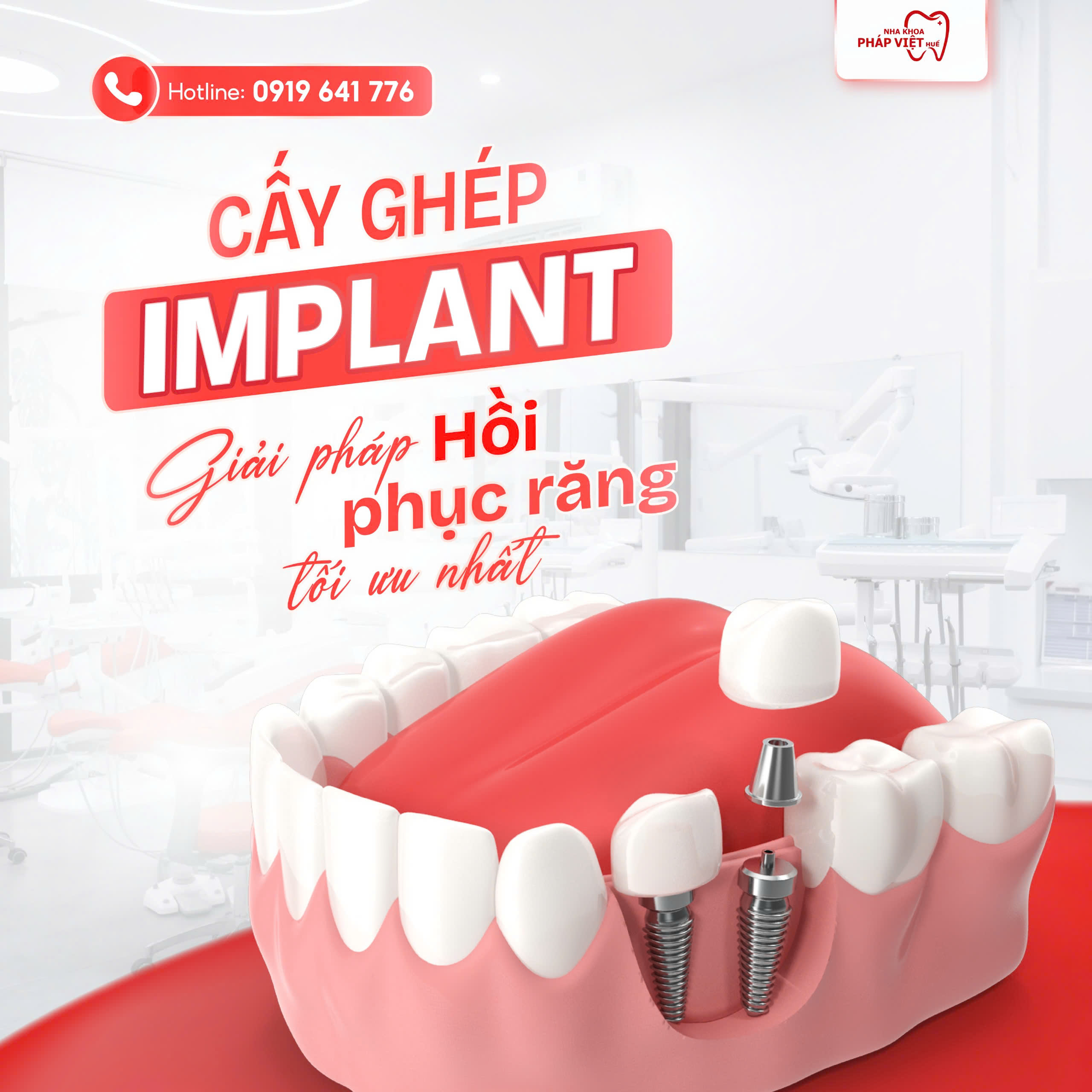 ca%cc%82y-ghep-implant